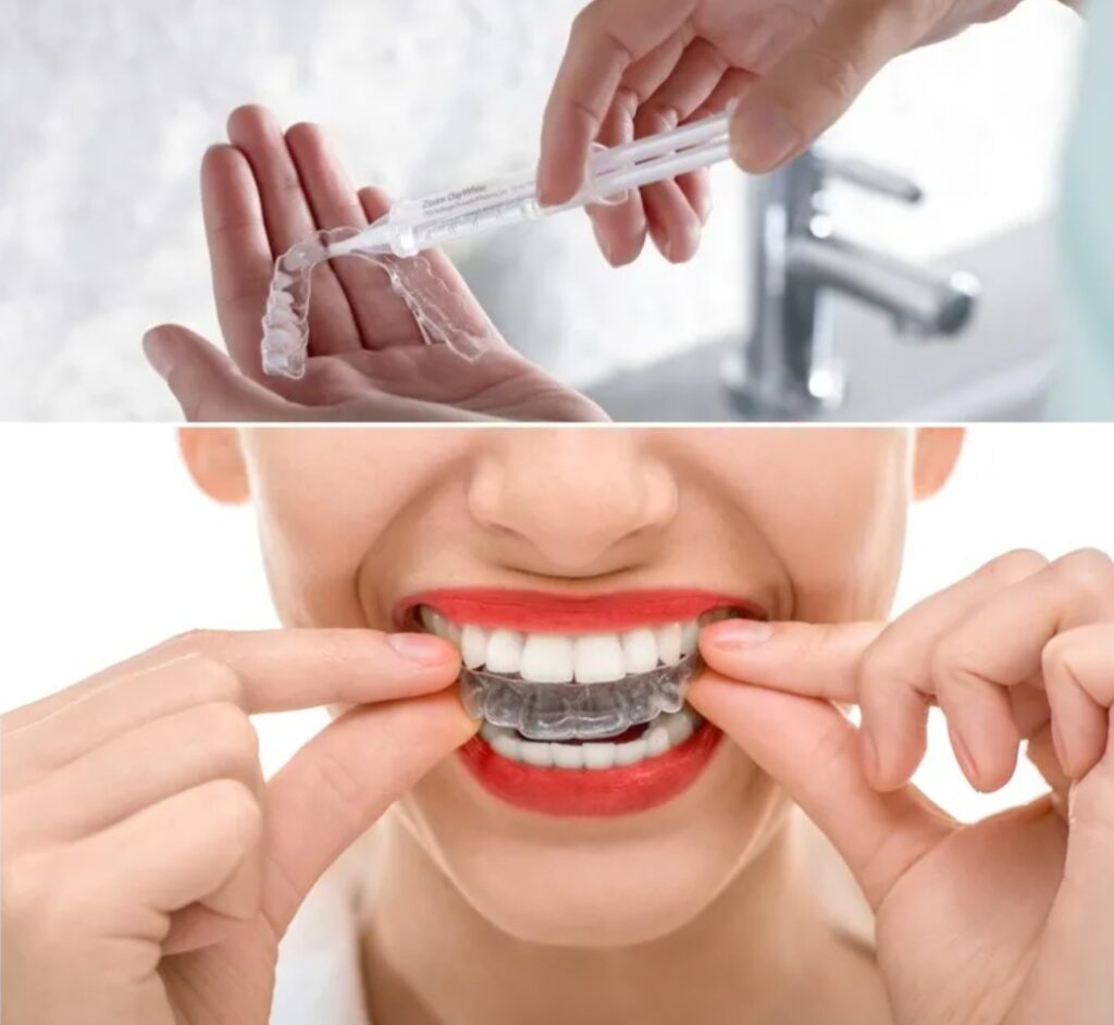 Домашнее отбеливание зубов