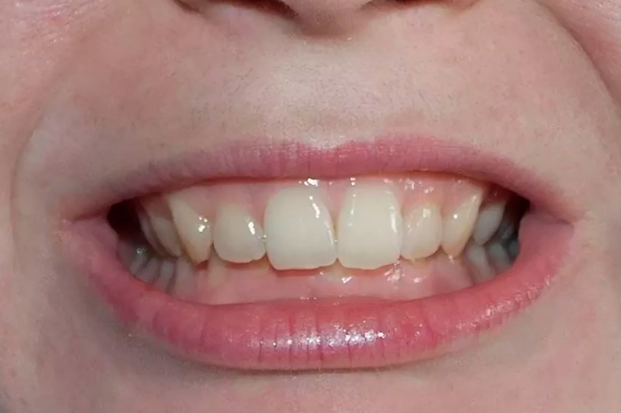 Зубы при закрытом рте. Глубокая резцовая окклюзия. Неправильный прикус Верхние зубы перекрывают нижние.
