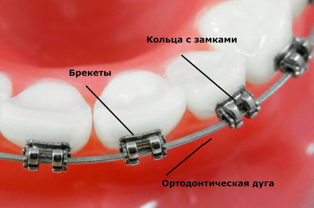 ортодонтическая дуга фото