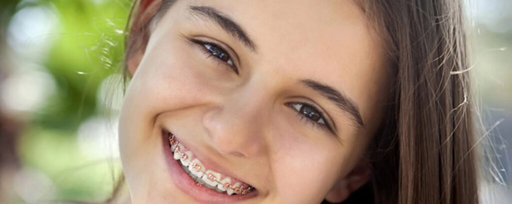 фото брекеты на зубах у детей