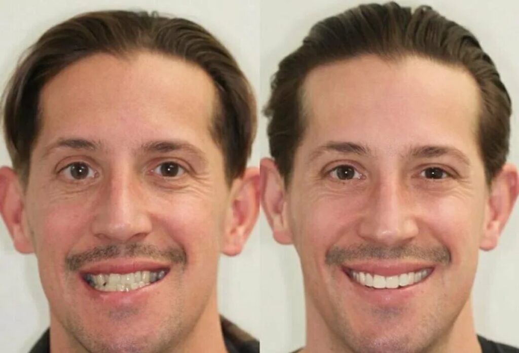 как брекеты меняют лицо человека фото