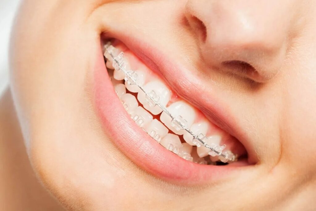 прозрачные брекеты на зубы фото