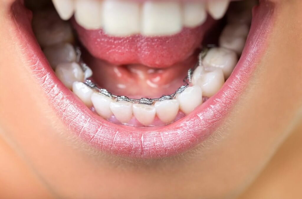 брекеты на нижние зубы фото