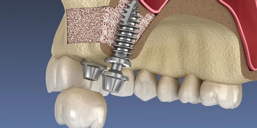 имплантация зубов без костной пластики фото