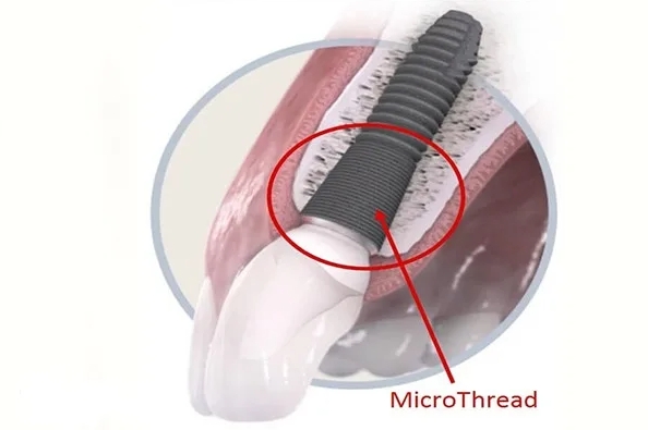 Резьба MicroThread: защита от атрофии кости фото