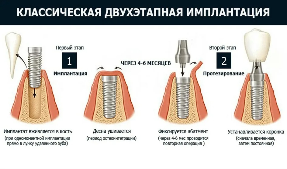 Этапы имплантации зубов схема