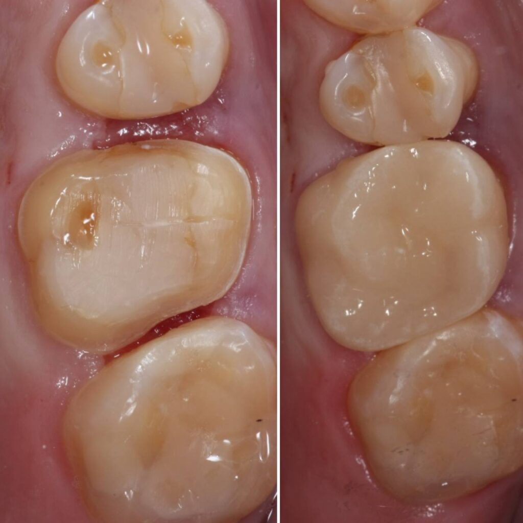 Восстановление коронки зуба методом керамической реставрации E-мах фото