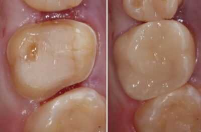 Восстановление коронки зуба методом керамической реставрации E-мах фото