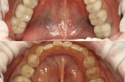 тотальное восстановление зубов керамическими реставрациями ФОТО