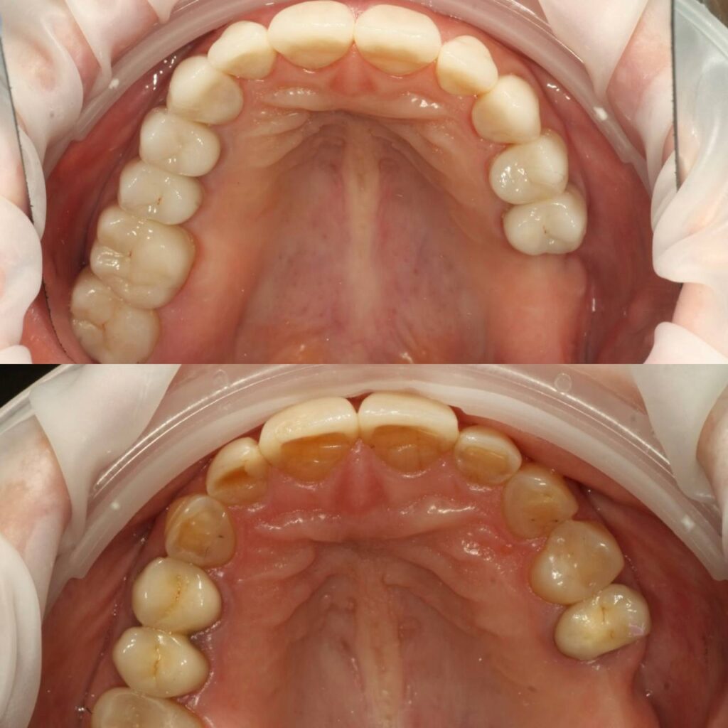 Тотальное восстановление зубов верхней челюсти керамическими реставрациями E-max фото