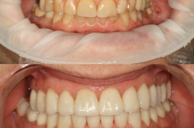 тотальное восстановление зубов с помощью керамических реставраций фото