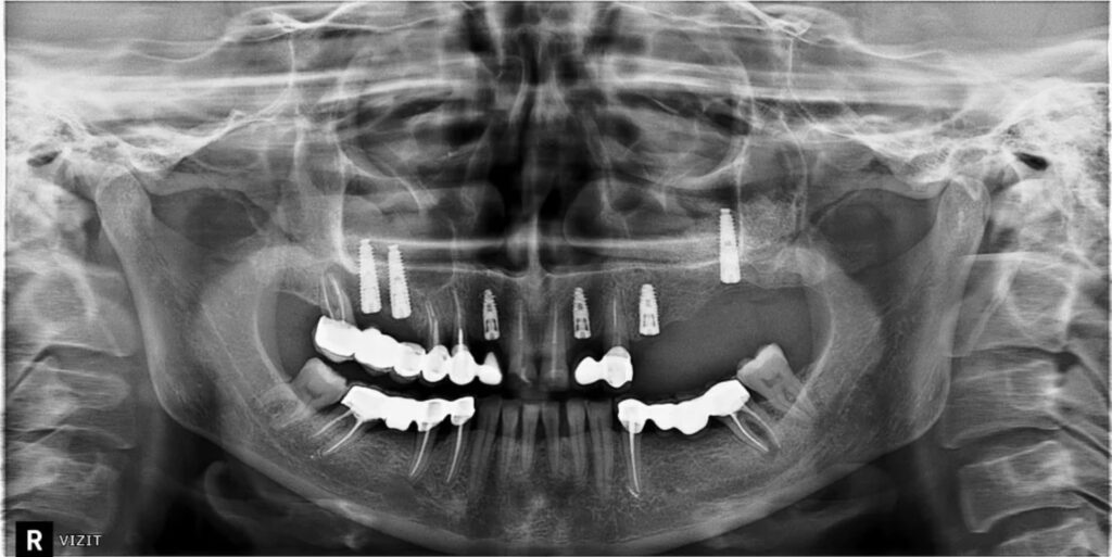 имплантация зубов гайморова пазуха фото