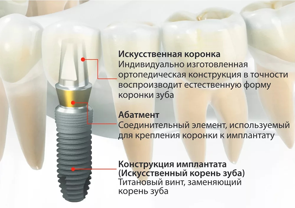 имплантация зубов насморк фото