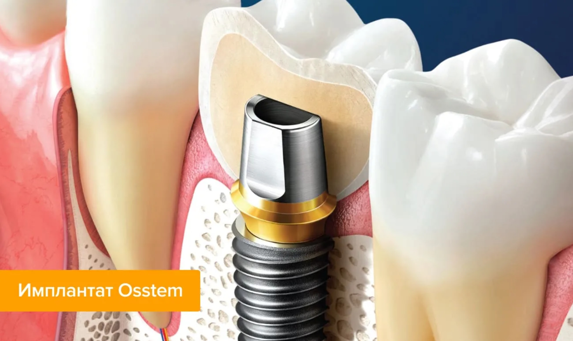 Производители имплантов. Корейские импланты зубов Osstem. Имплантат Осстем абатмент. Имплантация корейский Osstem. Корейский имплант зуба Osstem.