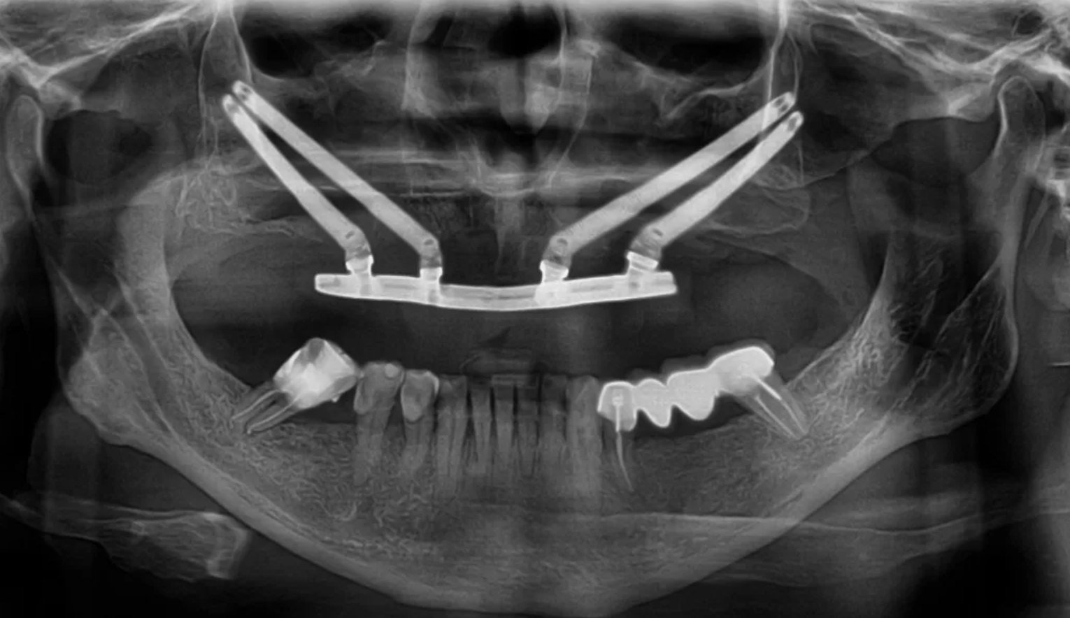Зигома. Скуловые импланты Nobel Zygoma. Скуловая имплантация Зигома.
