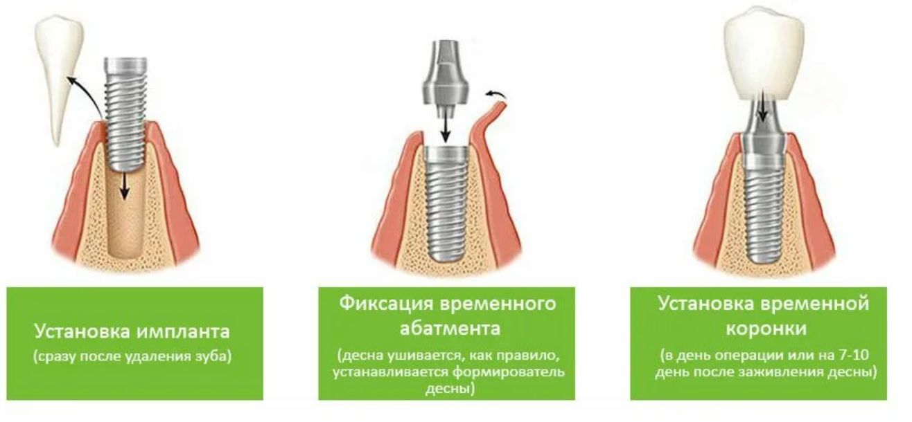 Зубы импланты поэтапно. Импланты схема установки имплантация. Этапы имплантации зубов. Этапы установления импланта зуба.