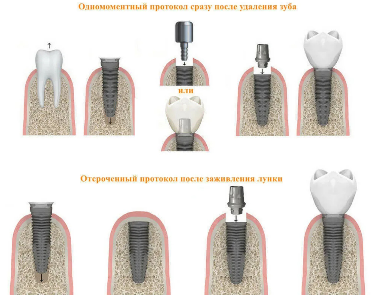 Зуб после душа. Имплант абатмент Десна коронка. Одномоментная имплантация двухэтапная. Одноэтапная методика имплантации.