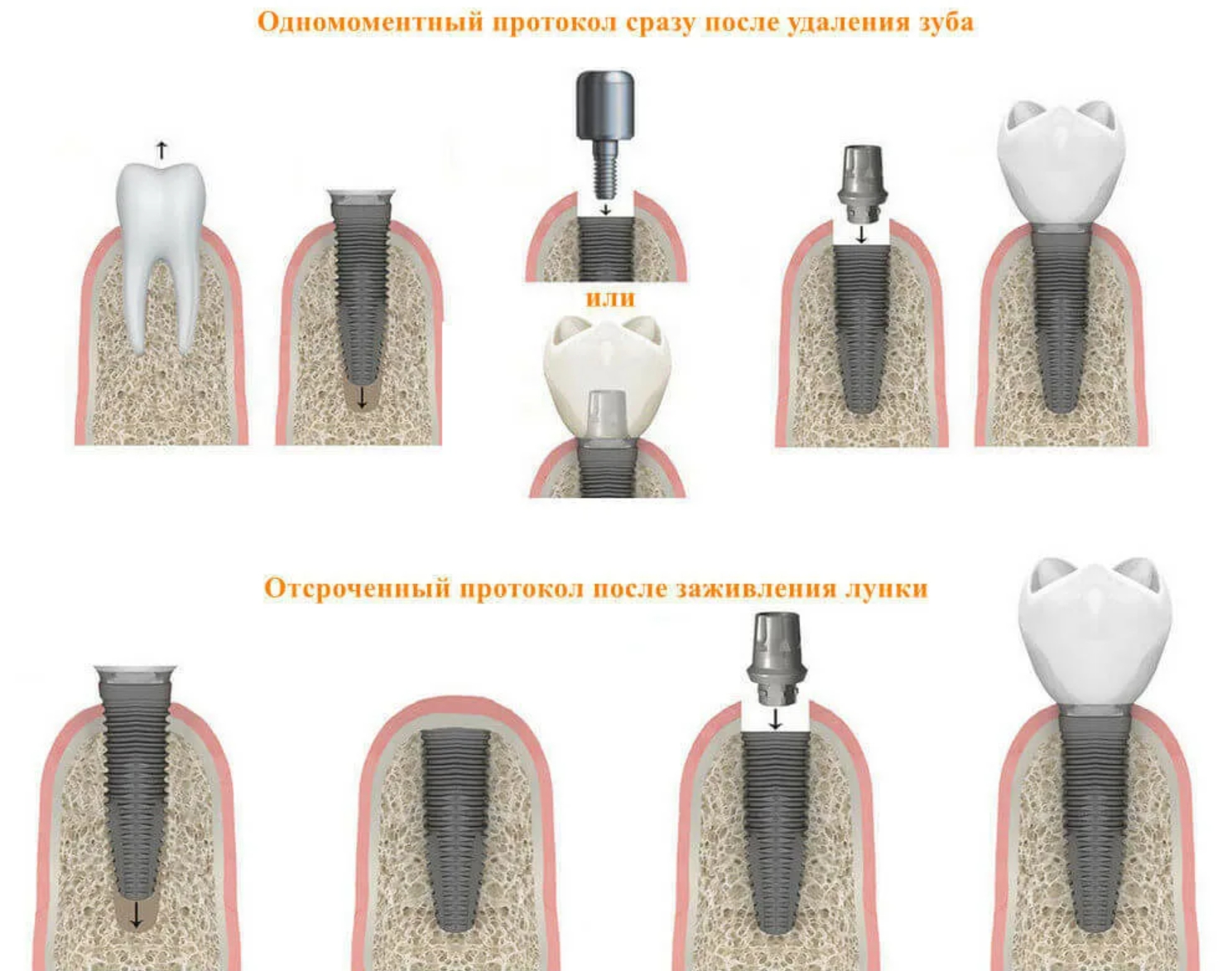 Сколько дней после удаления. Этапы одномоментной имплантации зуба. Одноэтапная методика имплантации. Одноэтапная имплантация зуба. Имплант зуба этапы одномоментный.