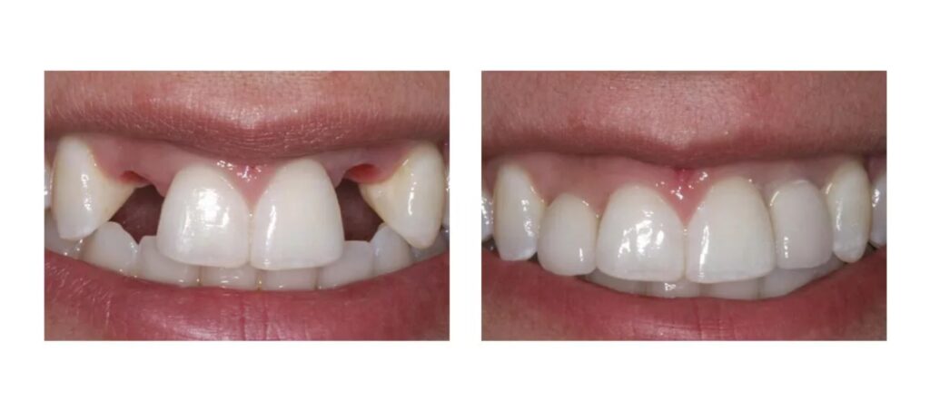 имплантация 2 зубов фото