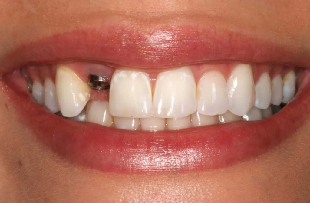 имплантация верхних зубов фото