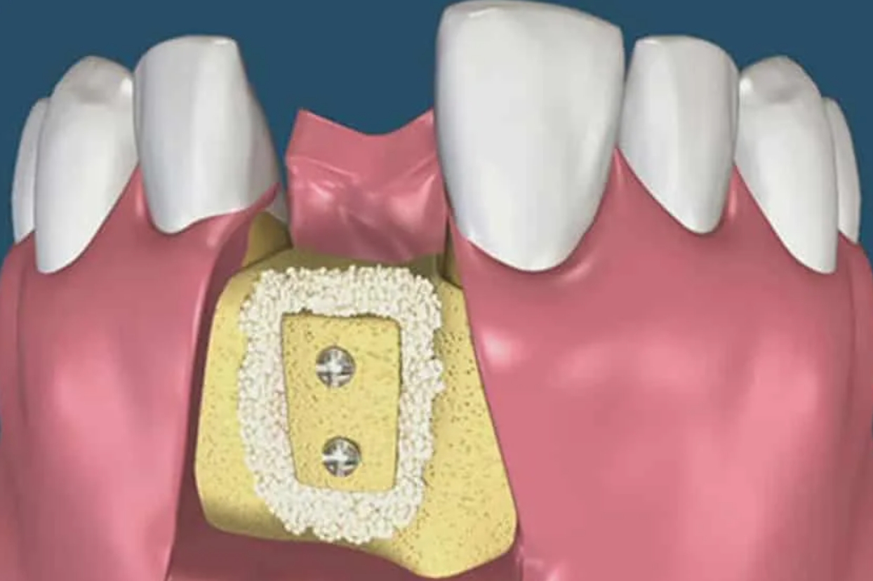 Зуб без кости. Аугментация костной ткани. Костная пластика (остеопластика). Костная пластика аугментация. Аутотрансплантация костной ткани челюсти.