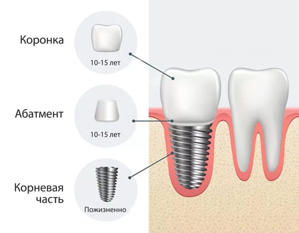 Срок службы имплантов зубов фото
