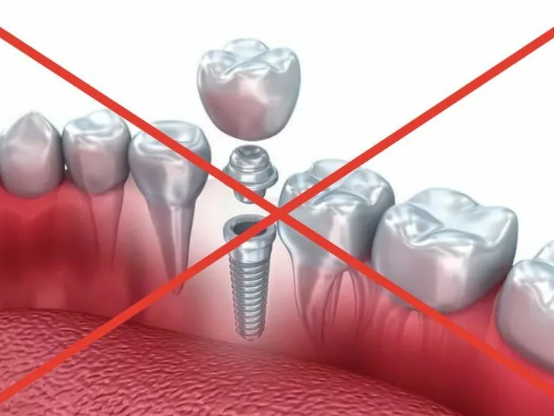 Что нельзя делать после установки. Имплантация противопоказана. Зубной имплантат. Имплантация зубов осложнения.