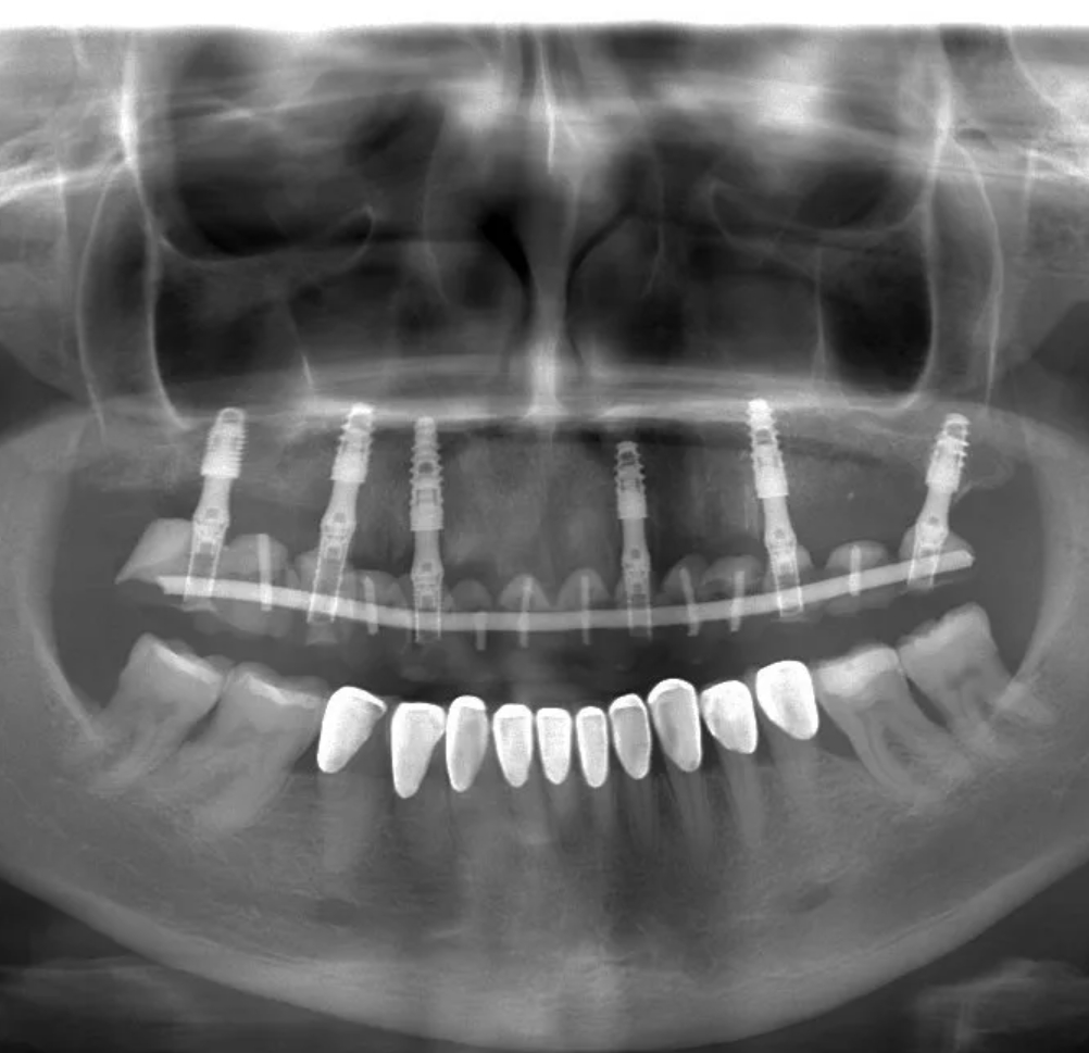 имплантация верхних зубов фото