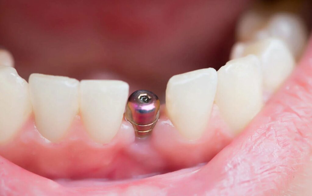 имплантация зубов десна фото