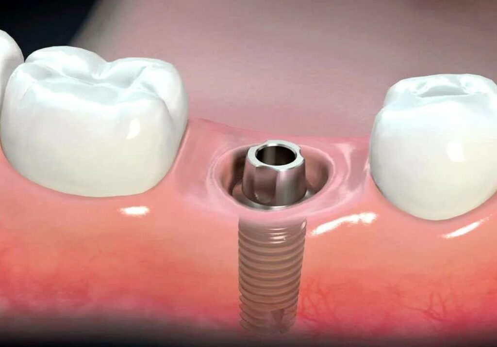 имплантация зубов без десны фото 