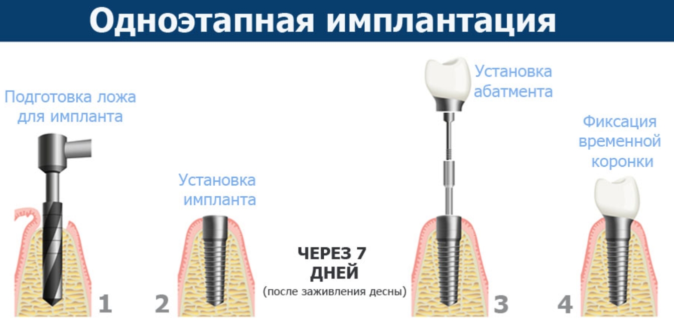 Пошагово как ставить импланты. Двухэтапная методика имплантации. Метод одноэтапной имплантации. Импланты схема установки. Этапы имплантации зубов схема.