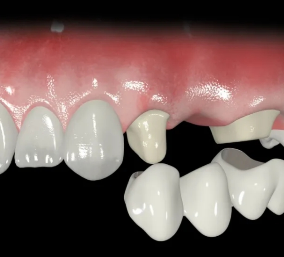 несъёмное протезирование зубов фото