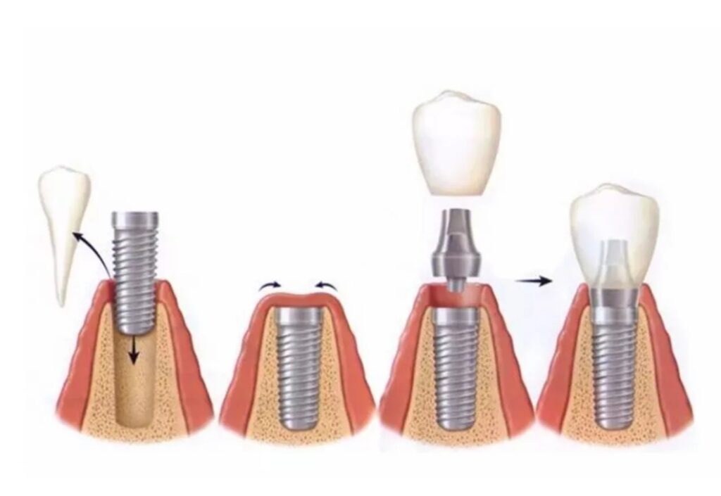 технология имплантации зубов фото