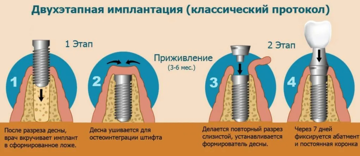 Схема установки имплантов зубов на нижней челюсти