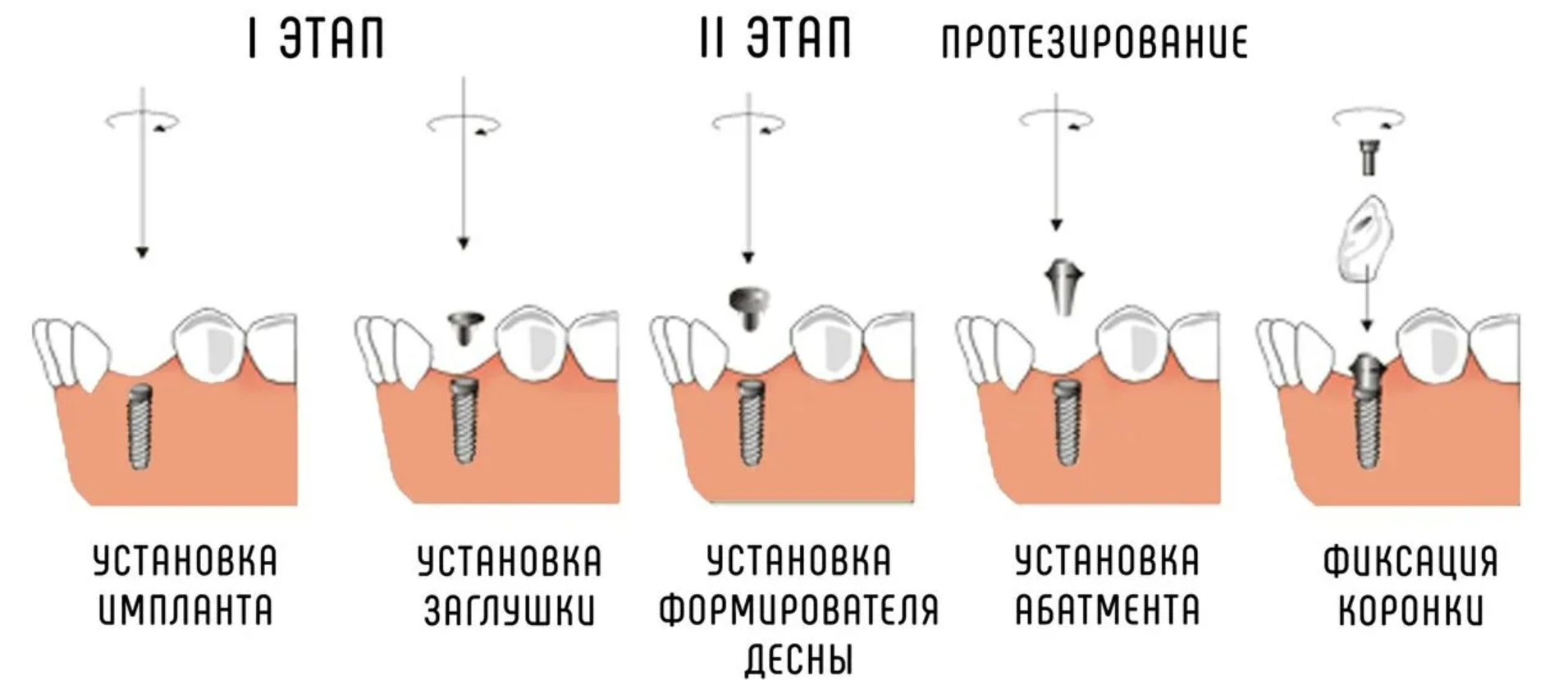 Зубы импланты поэтапно. Импланты схема установки. Схема установки зубного импланта. Как устанавливается имплант зуба этапы. Имплант зуба схема установки.
