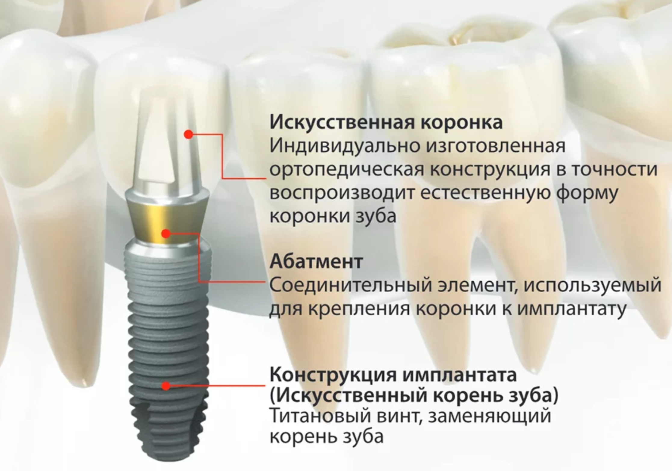 Зубные импланты картинки