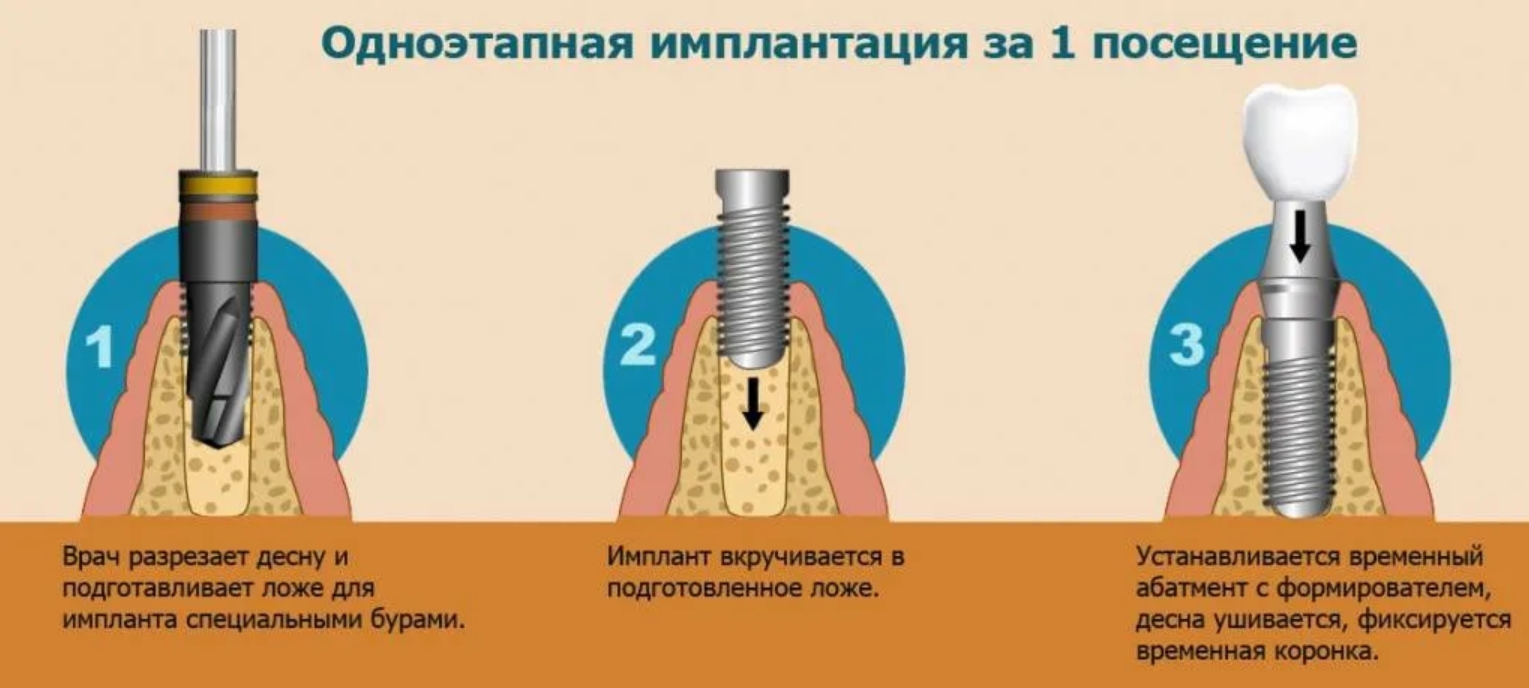 Через какое время можно вставить. Двухэтапная методика имплантации. Двухэтапная методика имплантации зубов. Одноэтапная методика имплантации. Одноэтапная методика имплантации этапы.