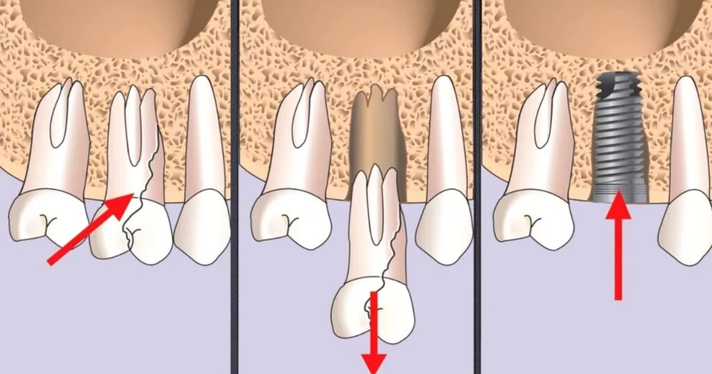 удаление зуба с одномоментной имплантацией фото