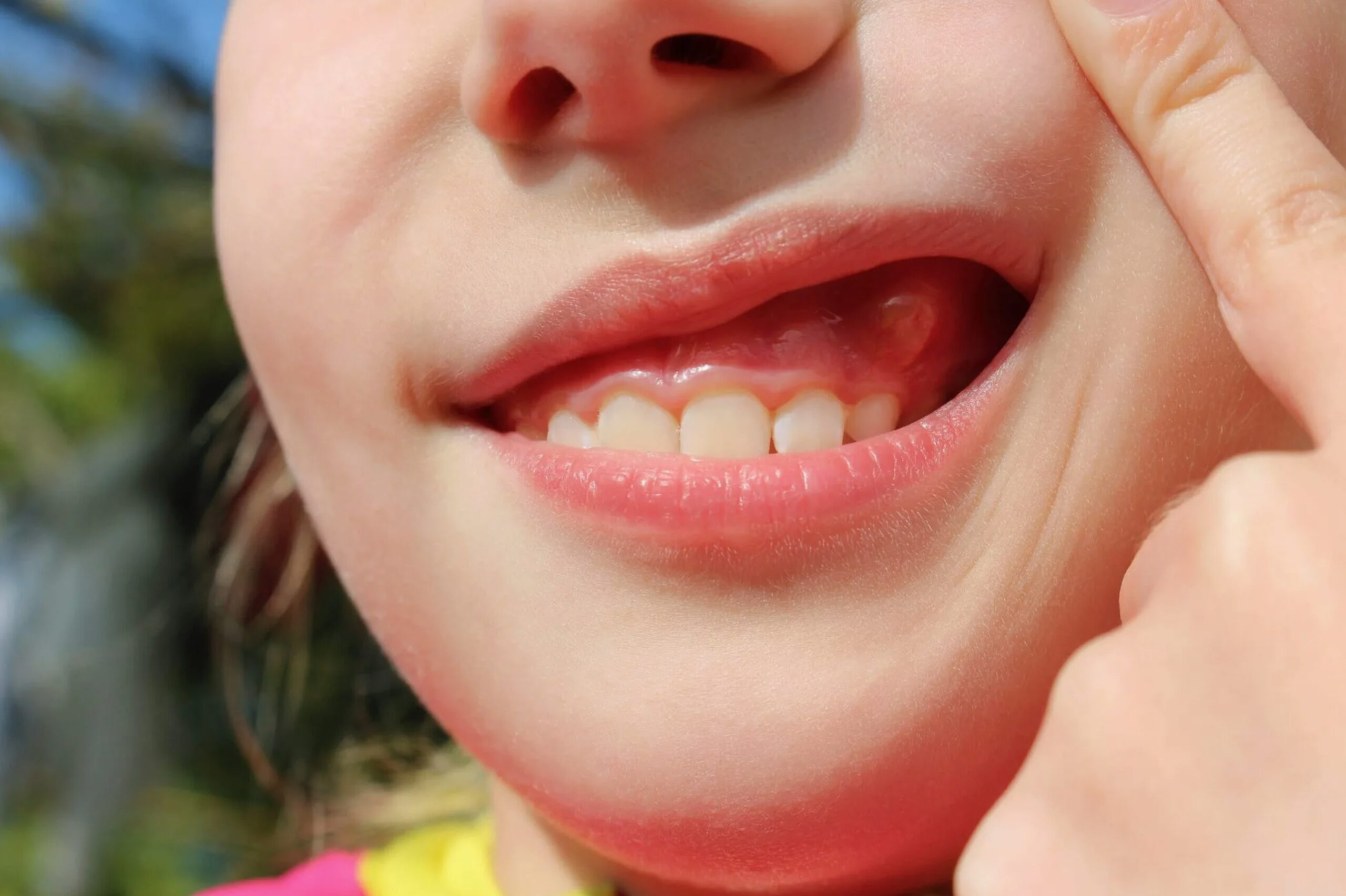 Что делать, если опухла (воспалилась) десна возле зуба и болит, отдавая в зубы?