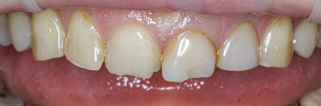 Протезирование передних зубов с помощью керамических коронок и виниров (Корогодин В.С.) 05.12.2023
