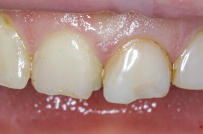 Протезирование передних зубов с помощью керамических коронок и виниров