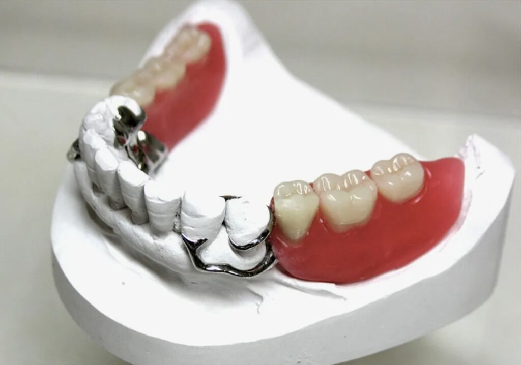 как делают протезирование зубов фото