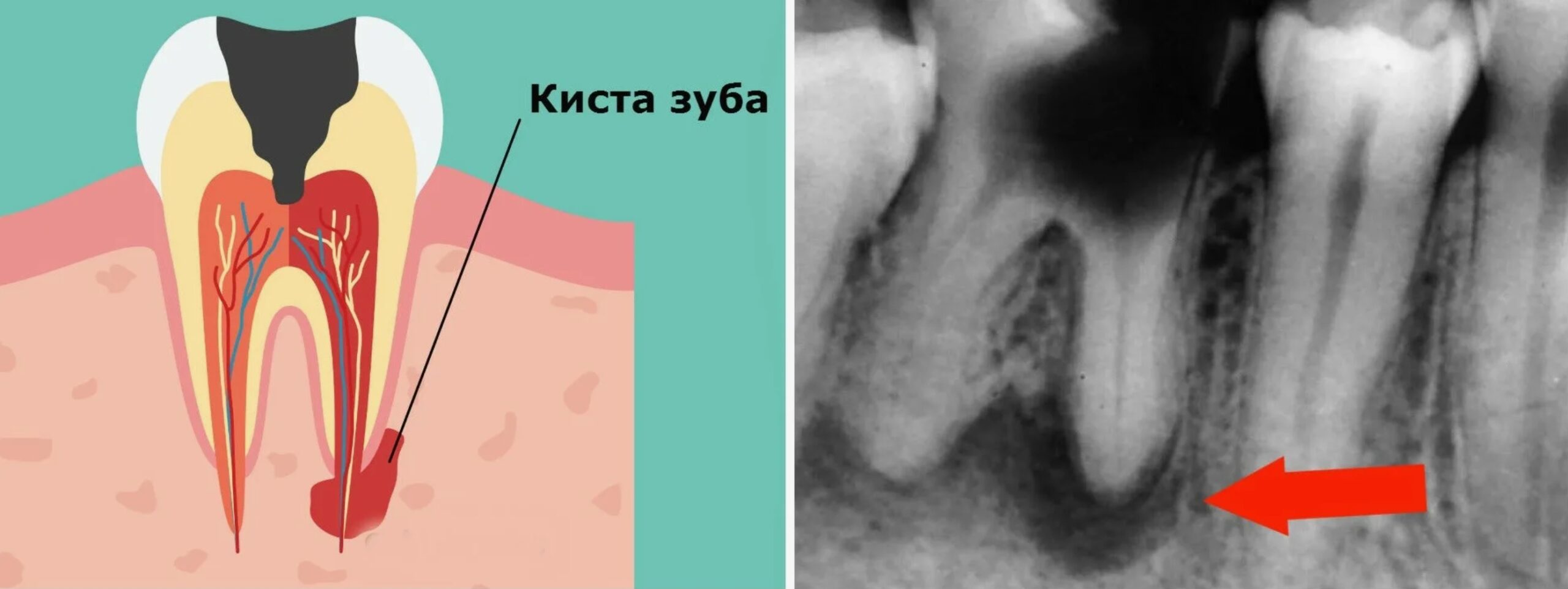 Киста зуба - лечится или нет, как можно вылечить и когда удалять зуб