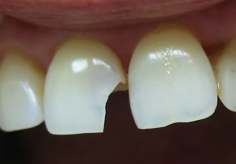 перелом коронки зуба фото