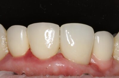 реставрация зуба диоксид циркониевой коронкой.
