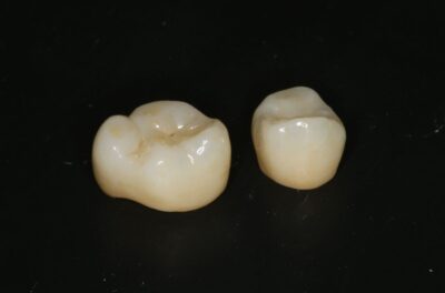 реставрация Зубов одиночными коронками из диоксида циркония