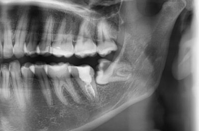 удаление ретинированного зуба 3.8 (зуб мудрости) фото