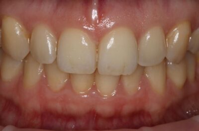 Отбеливание системой zoom4 фото