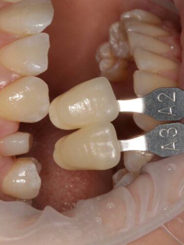 Протезирование зуба в концепции BOPT диоксидом циркония