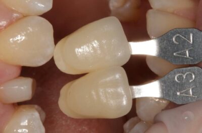 Протезирование зуба в концепции BOPT диоксидом циркония